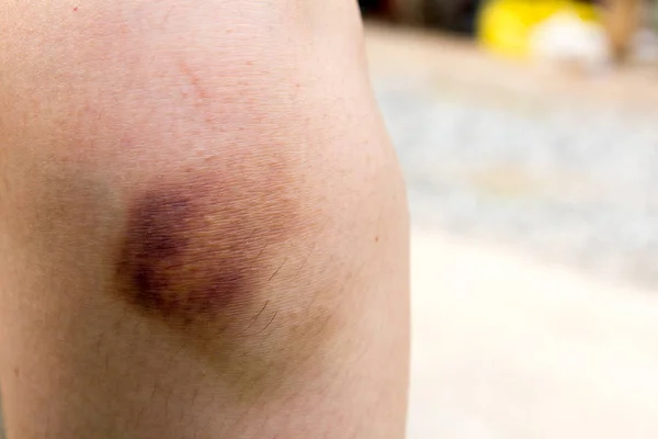 Contusão marrom no fundo do joelho da mulher — Fotografia de Stock