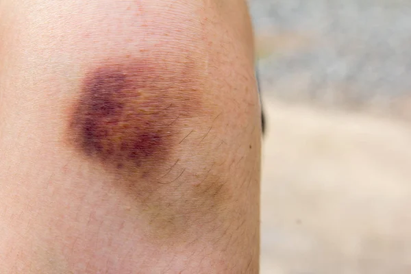 Contusão marrom no fundo do joelho da mulher — Fotografia de Stock