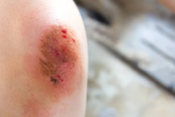Μελανιασμένο πληγή τραυματισμού στο γόνατο φόντο γυναίκα — Φωτογραφία Αρχείου