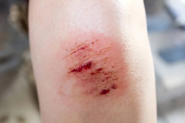 Pohmožděný hojení poranění na pozadí kolena žena — Stock fotografie