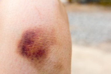 Kahverengi kadın diz arka plan üzerinde çürük