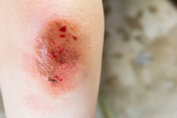 Lesões na ferida no fundo do joelho da mulher — Fotografia de Stock