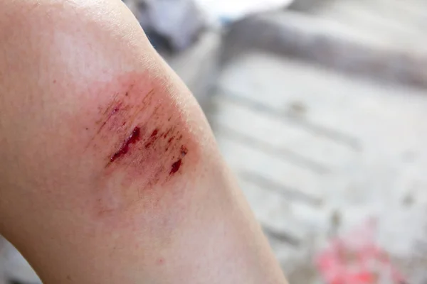 Lesões na ferida no fundo do joelho da mulher — Fotografia de Stock