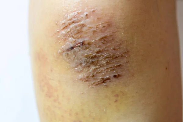 Закрита травма червоного шраму на коліно жінки — стокове фото