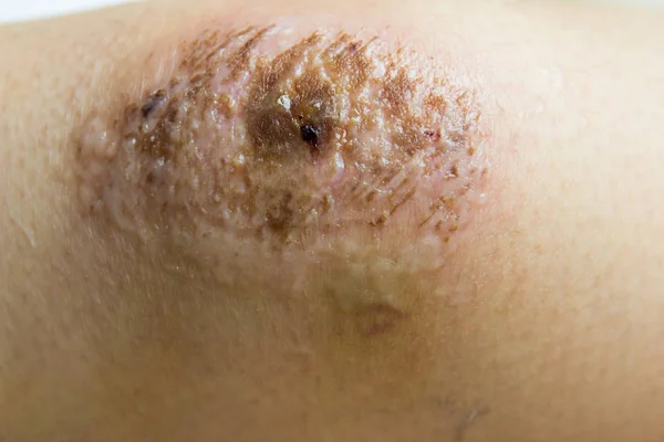 Closed up of red scab injury on woman knee background — Stock Photo, Image