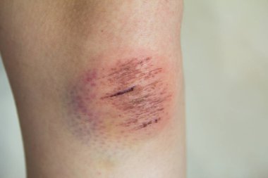 Lenf ve kan Asyalı kadın diz arka plan üzerinde taze yara