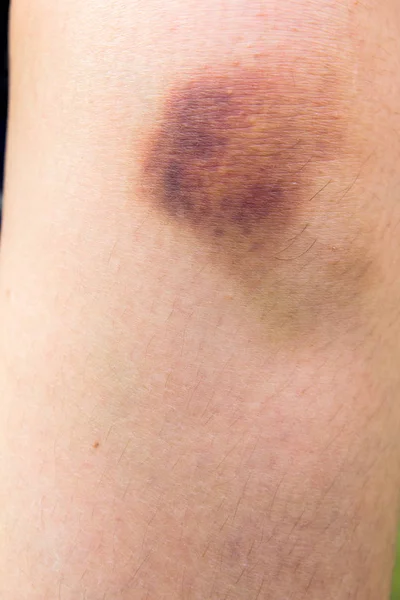 Brown bruise on woman knee background — Stock Photo, Image