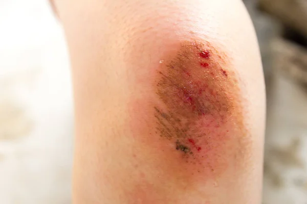 Gekneusd wond letsel op vrouw knie achtergrond — Stockfoto