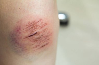 Lenf ve kan Asyalı kadın diz arka plan üzerinde taze yara