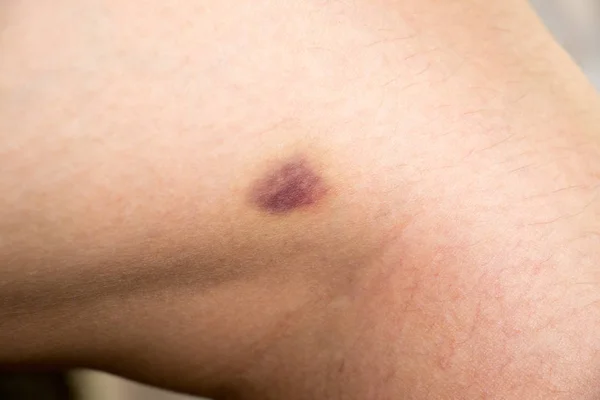 Closed up of bruised injury on woman leg background — Stock Photo, Image