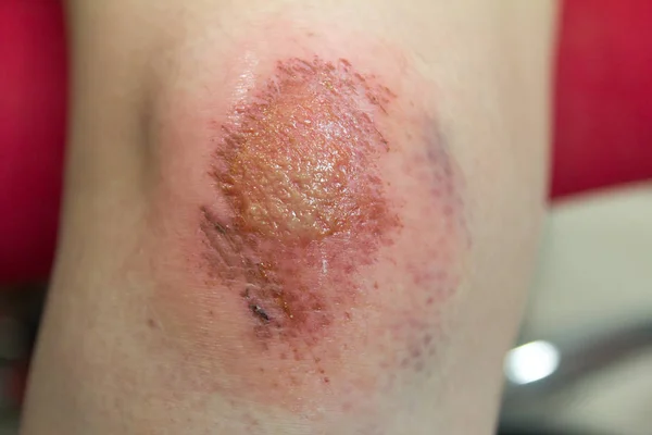 Färska sår med lymfa och blod på asiatiska kvinnliga knä bakgrund — Stockfoto