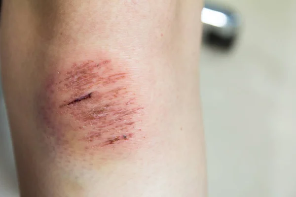 Fresh wound with lymph and blood on asian female knee background — Stock Photo, Image