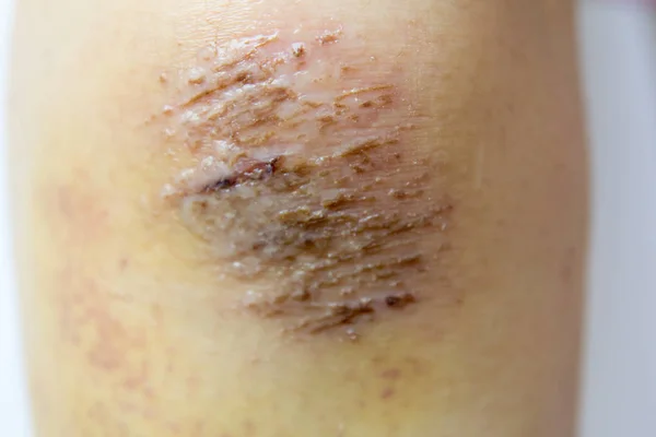 Fechado acima da lesão da crosta vermelha no fundo do joelho da mulher — Fotografia de Stock