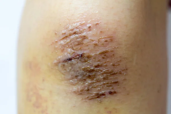 Cerrado de herida de costra roja en el fondo de rodilla de la mujer — Foto de Stock