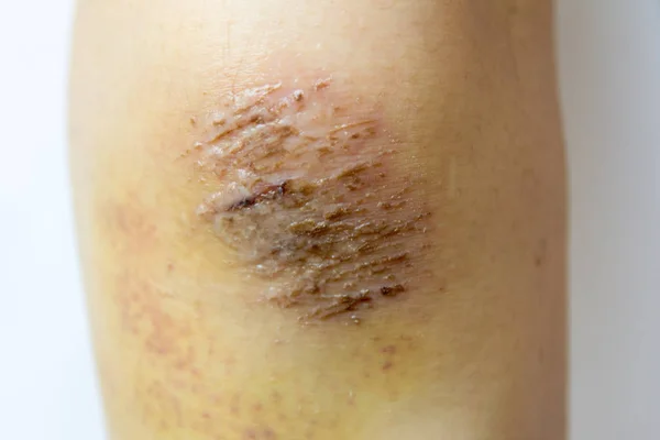 Closed up of red scab injury on woman knee background — Stock Photo, Image