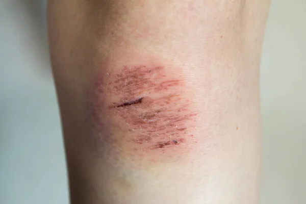 Fresh wound with lymph and blood on asian female knee background — Stock Photo, Image