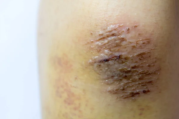 Fechado acima da lesão da crosta vermelha no fundo do joelho da mulher — Fotografia de Stock