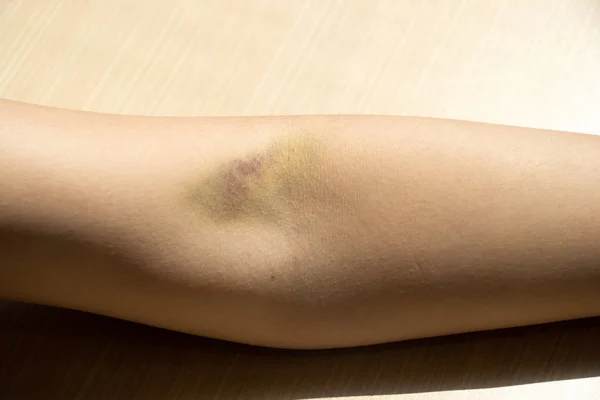Bruise injury on the female arm background — Stock Photo, Image