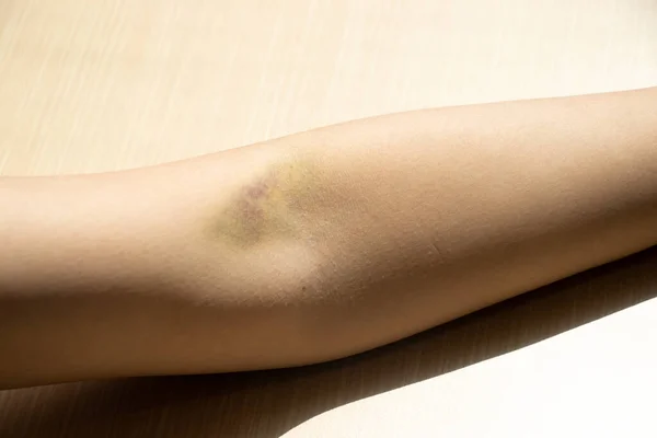 Τραυματισμός Μώλωπα Στο Γυναικείο Φόντο Του Βραχίονα — Φωτογραφία Αρχείου