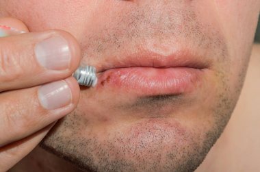 Merhem bir yara herpes bir adamın ağzında bir cilt hastalığı tedavisinde
