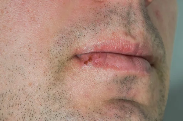 一个人的嘴唇上的疱疹皮肤疾病的伤口 — 图库照片