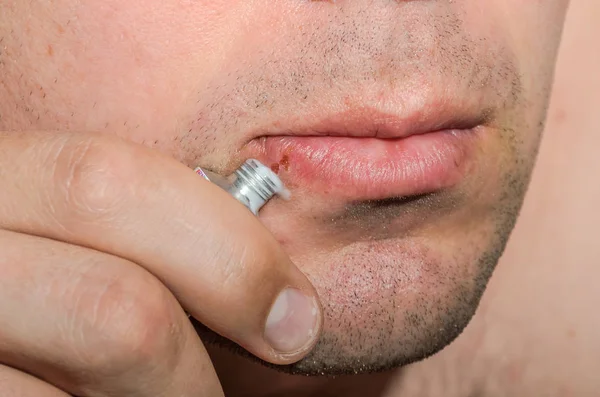 Tratamento Pomada Uma Ferida Uma Doença Pele Herpes Nos Lábios — Fotografia de Stock