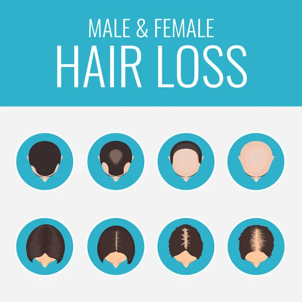 Αρσενικό και θηλυκό τα μαλλιά απώλεια σετ — Διανυσματικό Αρχείο
