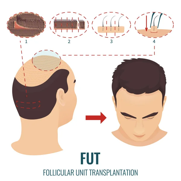 Trattamento di perdita di capelli FUT — Vettoriale Stock