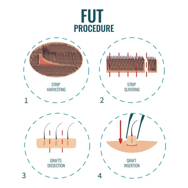 FUT tratamiento de pérdida de cabello — Archivo Imágenes Vectoriales