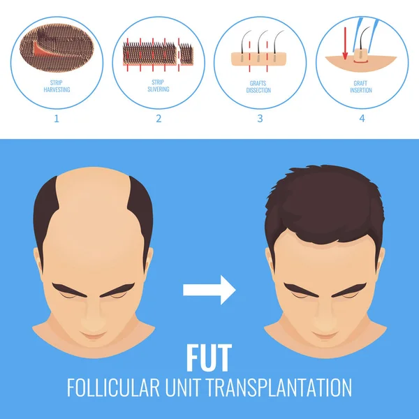 FUT saç dökülmesi tedavisi — Stok Vektör