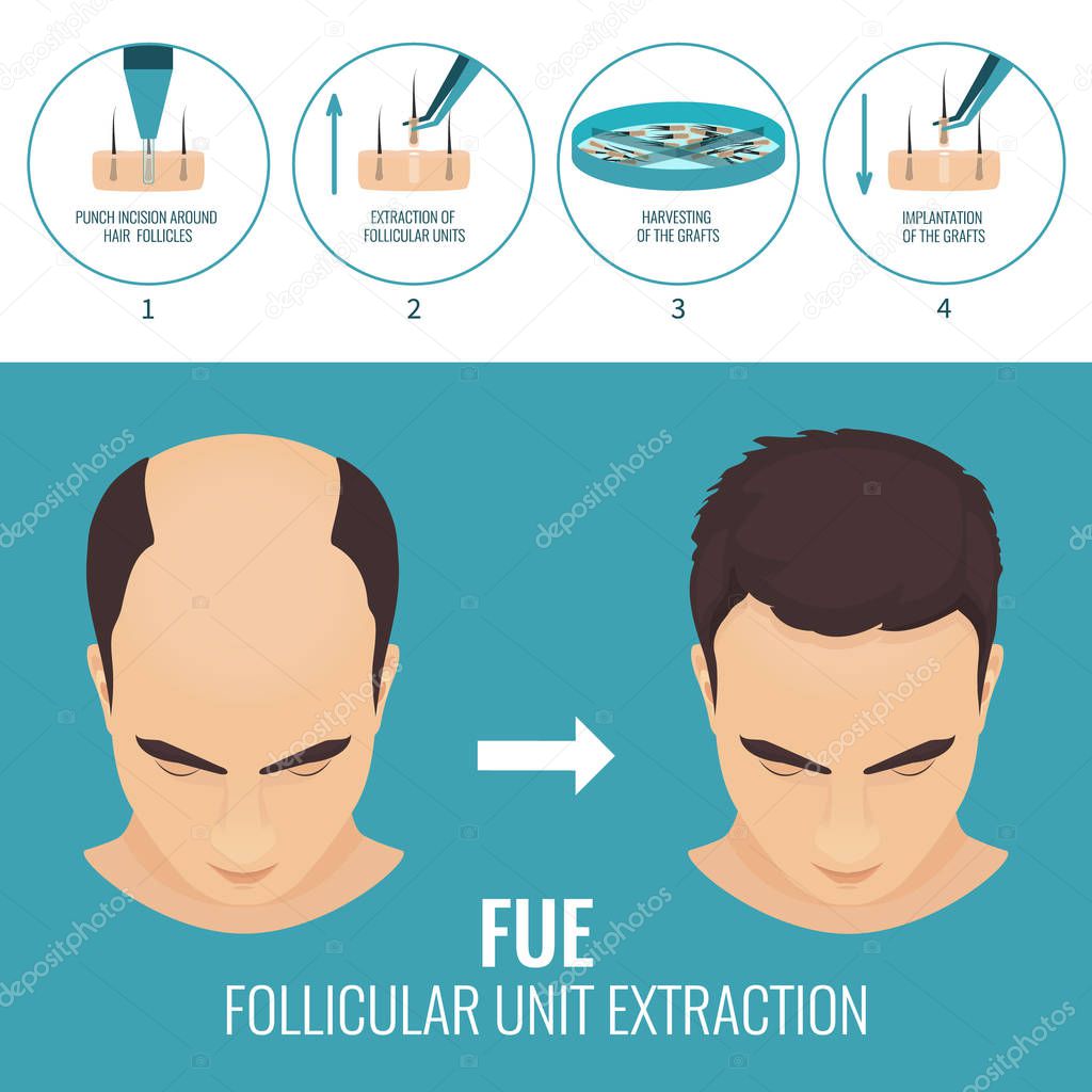 FUE hair loss treatment