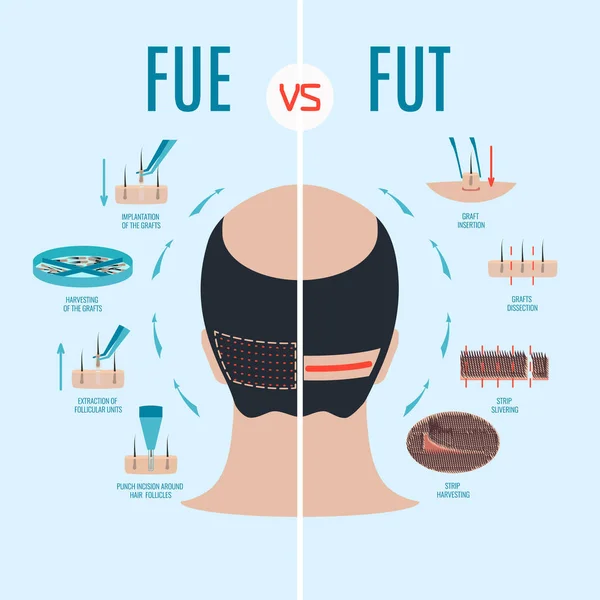 FUE vs FUT — Stok Vektör