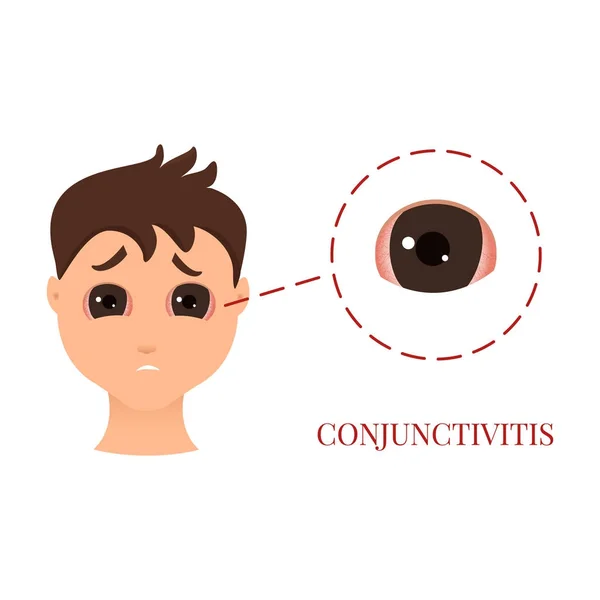 Человек с конъюнктивитом — стоковый вектор