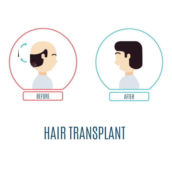 Transplante de cabelo para homens — Vetor de Stock