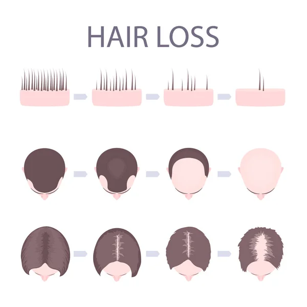 Male and female hair loss — Stock Vector