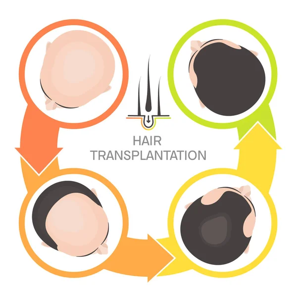 Vlasy transplantace 4 krok infografika — Stockový vektor