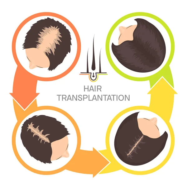 Trasplante de cabello para mujeres-4 paso infografías — Vector de stock