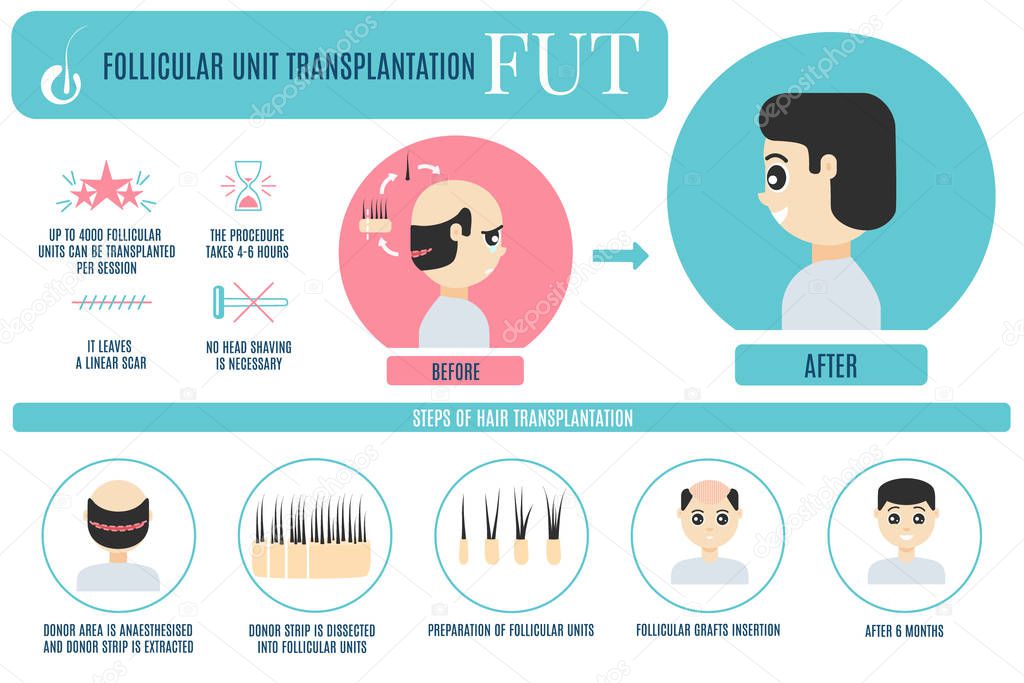 FUT hair transplantation for men