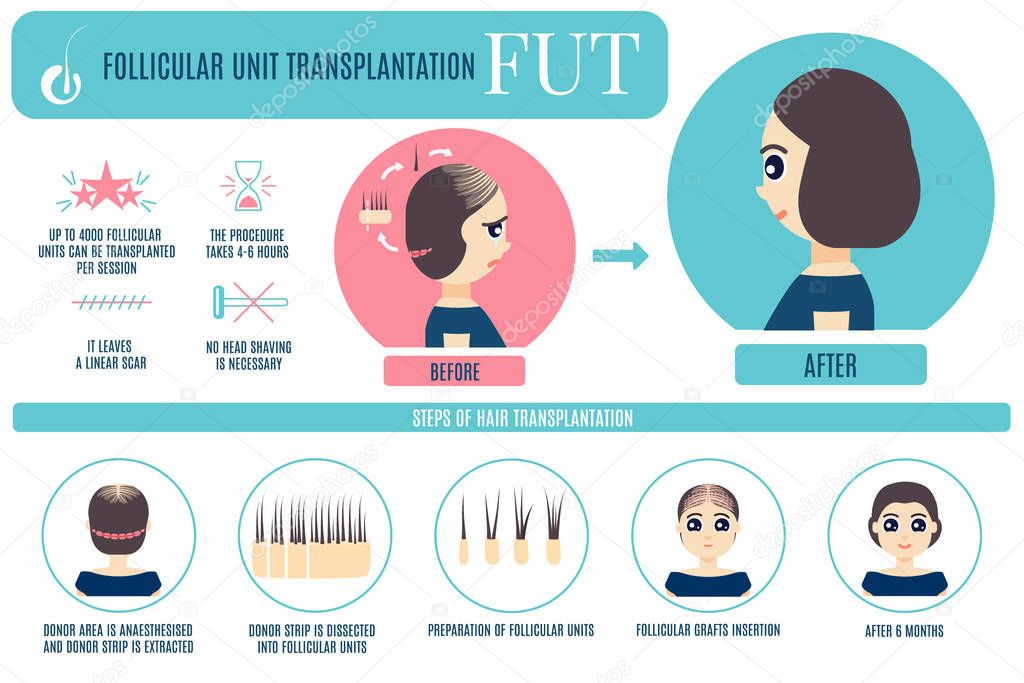 FUT hair transplantation for women