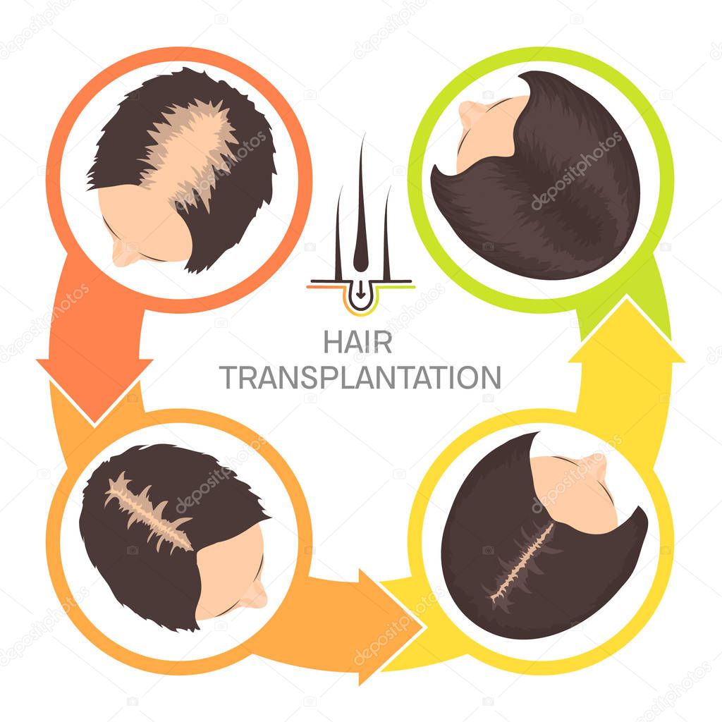 Hair transplantation for women-4 step infographics