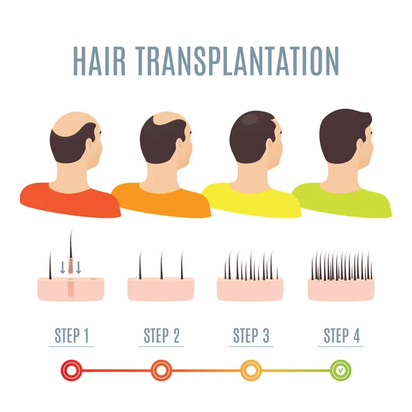 Trasplante de cabello en hombres — Vector de stock