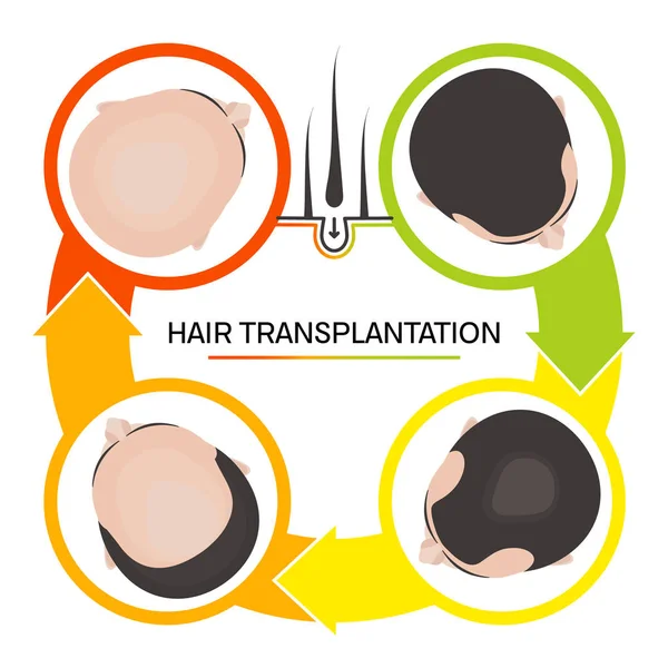 Hair transplantation 4 step infographics — Stock Vector