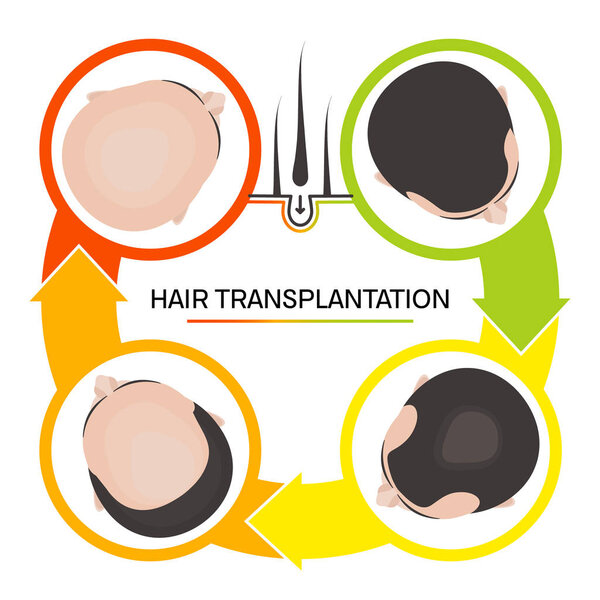 Hair transplantation 4 step infographics