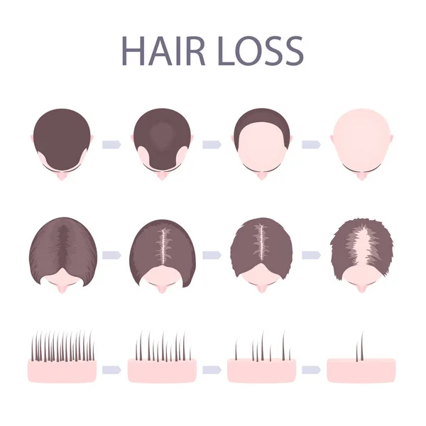 Erkek ve kadın saç dökülmesi — Stok Vektör