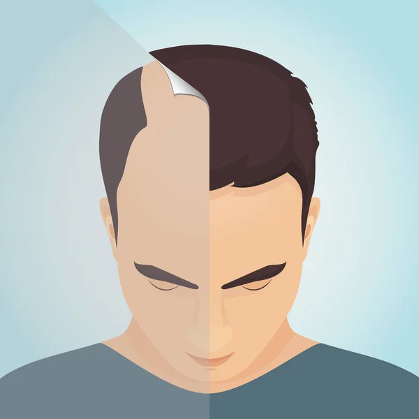 Perdita di capelli negli uomini — Vettoriale Stock