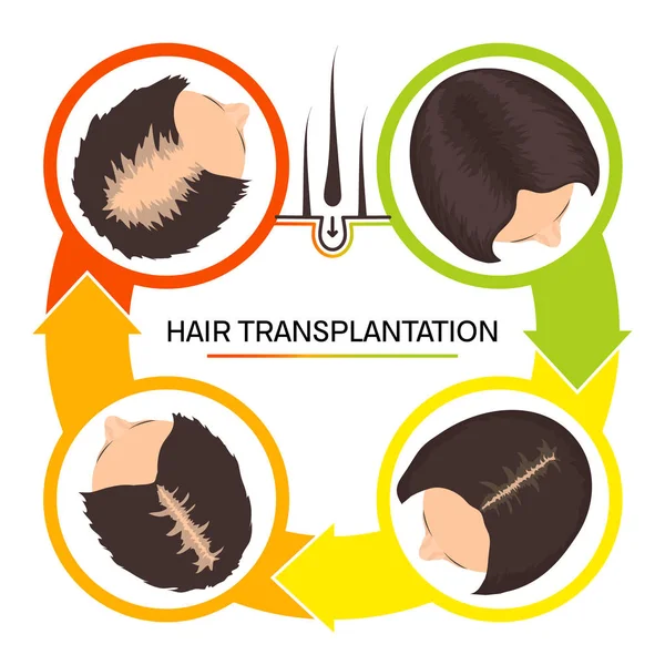 Hair transplantation for women 4 step infographics — Stock Vector