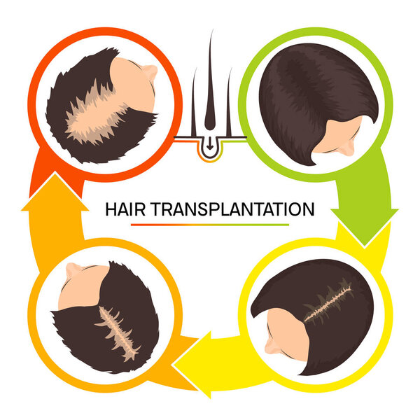 Hair transplantation for women 4 step infographics