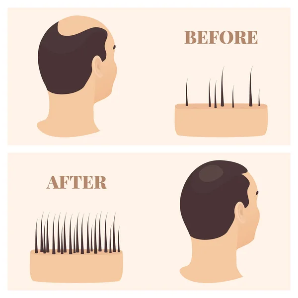 Homem em visão lateral antes e após o tratamento da perda de cabelo —  Vetores de Stock