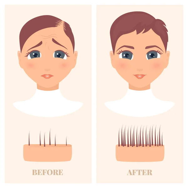 Mujer antes y después del tratamiento de pérdida de cabello en la vista frontal — Archivo Imágenes Vectoriales