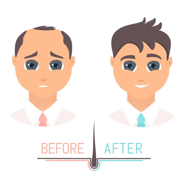 Man voor en na haaruitval behandeling in vooraanzicht — Stockvector